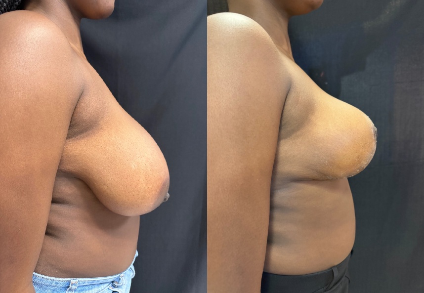before and after breast reduction NYC right side view case 33471