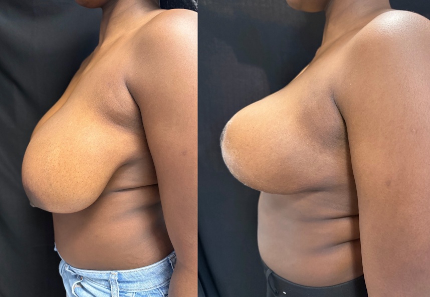 before and after breast reduction NYC left side view case 33471