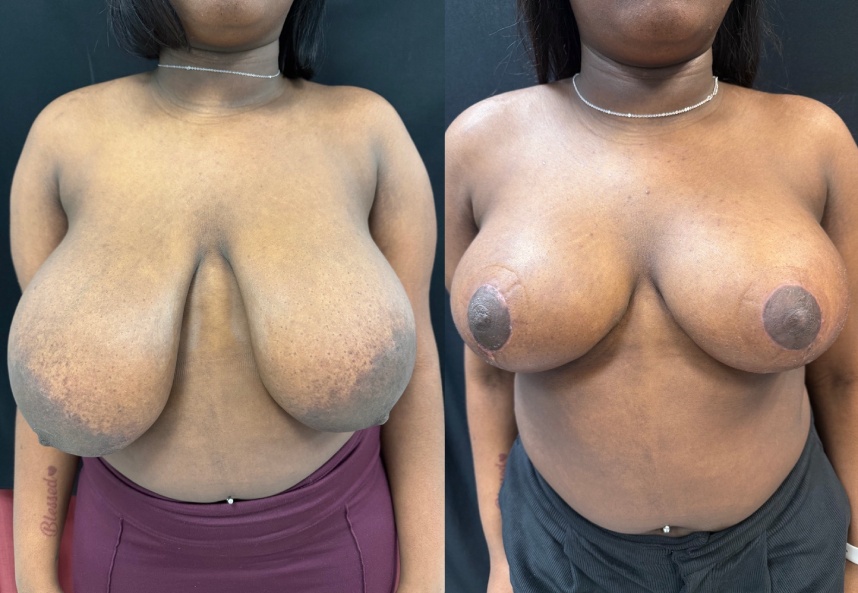 before and after breast reduction NYC front view case 33477