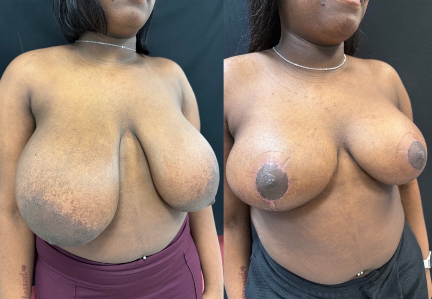 before and after breast reduction NYC right angle view case 33477