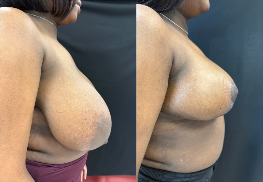 before and after breast reduction NYC right side view case 33477