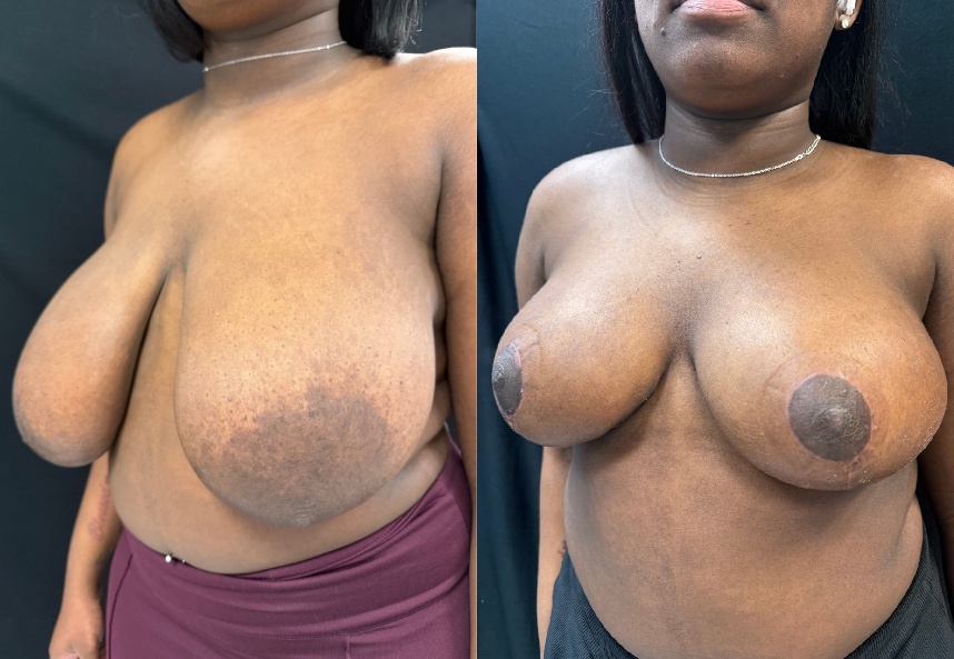 before and after breast reduction NYC left angle view case 33477