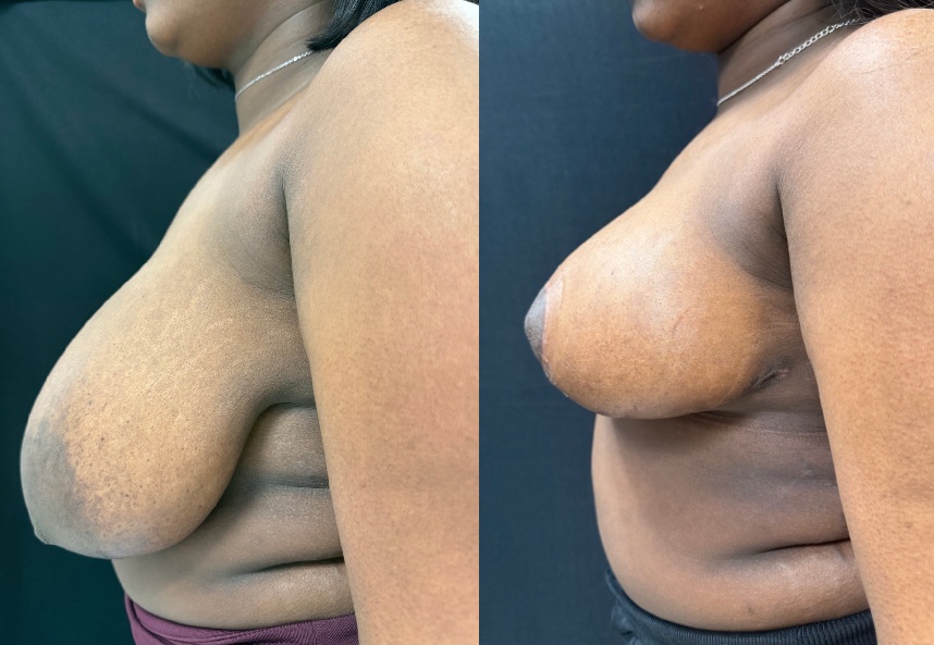 before and after breast reduction NYC left side view case 33477