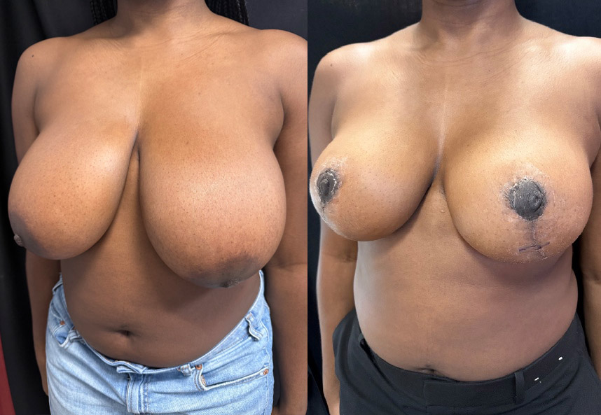 before and after breast reduction NYC left angle view case 33471