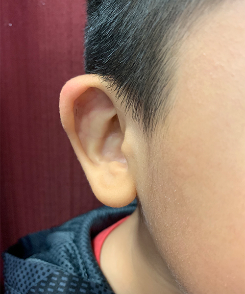 before ear shaping procedure NYC child patient right angle view case 33649
