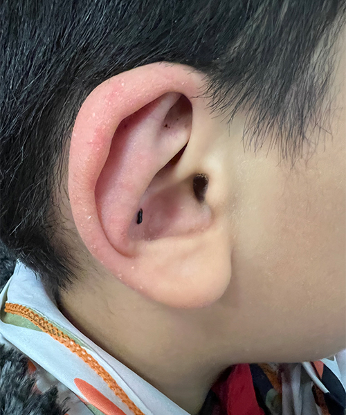 after ear shaping procedure NYC child patient right side case 33649