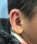 after ear shaping procedure NYC child patient right angle view case 33649