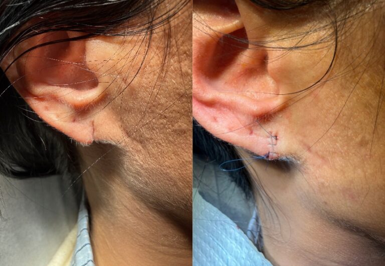 before and after earlobe revision Dr. Sabry Murray Hill Plastic Surgery case 33489