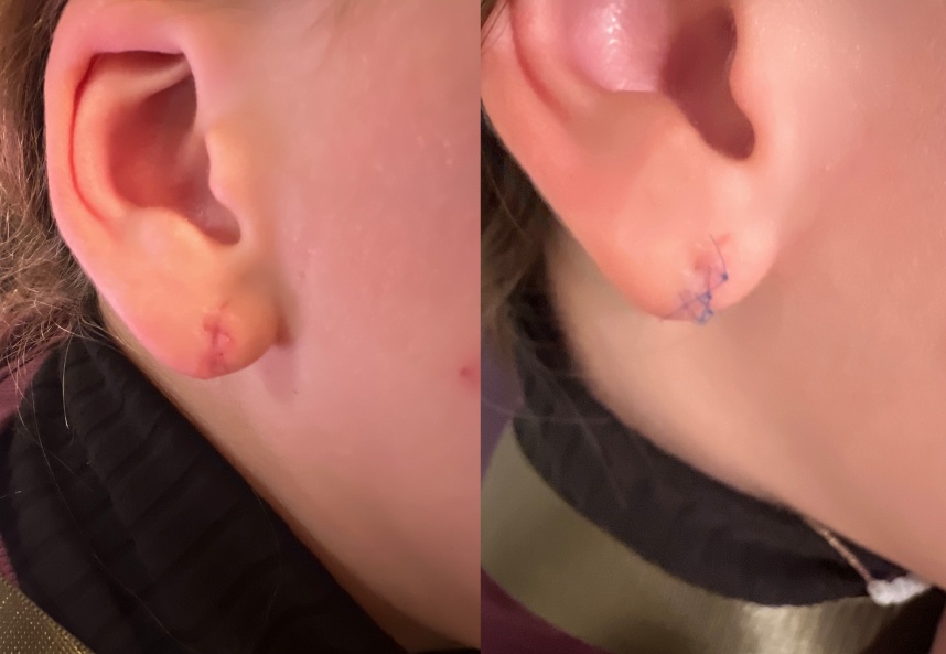 before and after earlobe revision NYC right side view case 33491